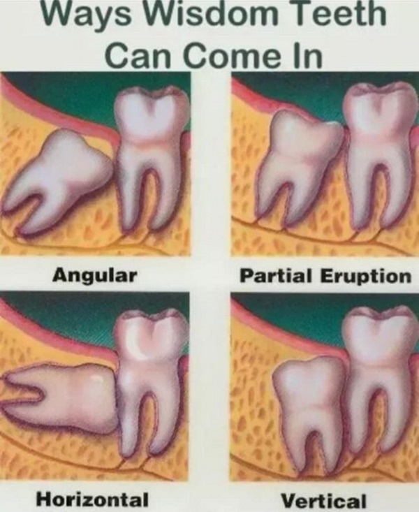 Wisdom Tooth Wisdom Tooth