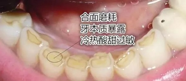 Bruxism Bruxism