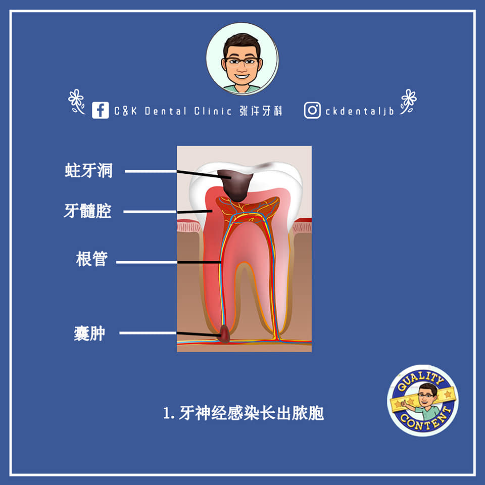 Wisdom Tooth