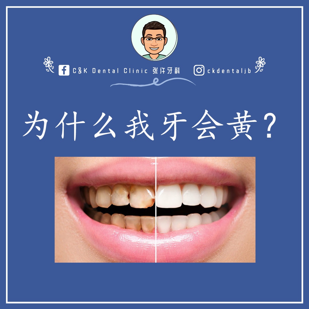 Wisdom Tooth