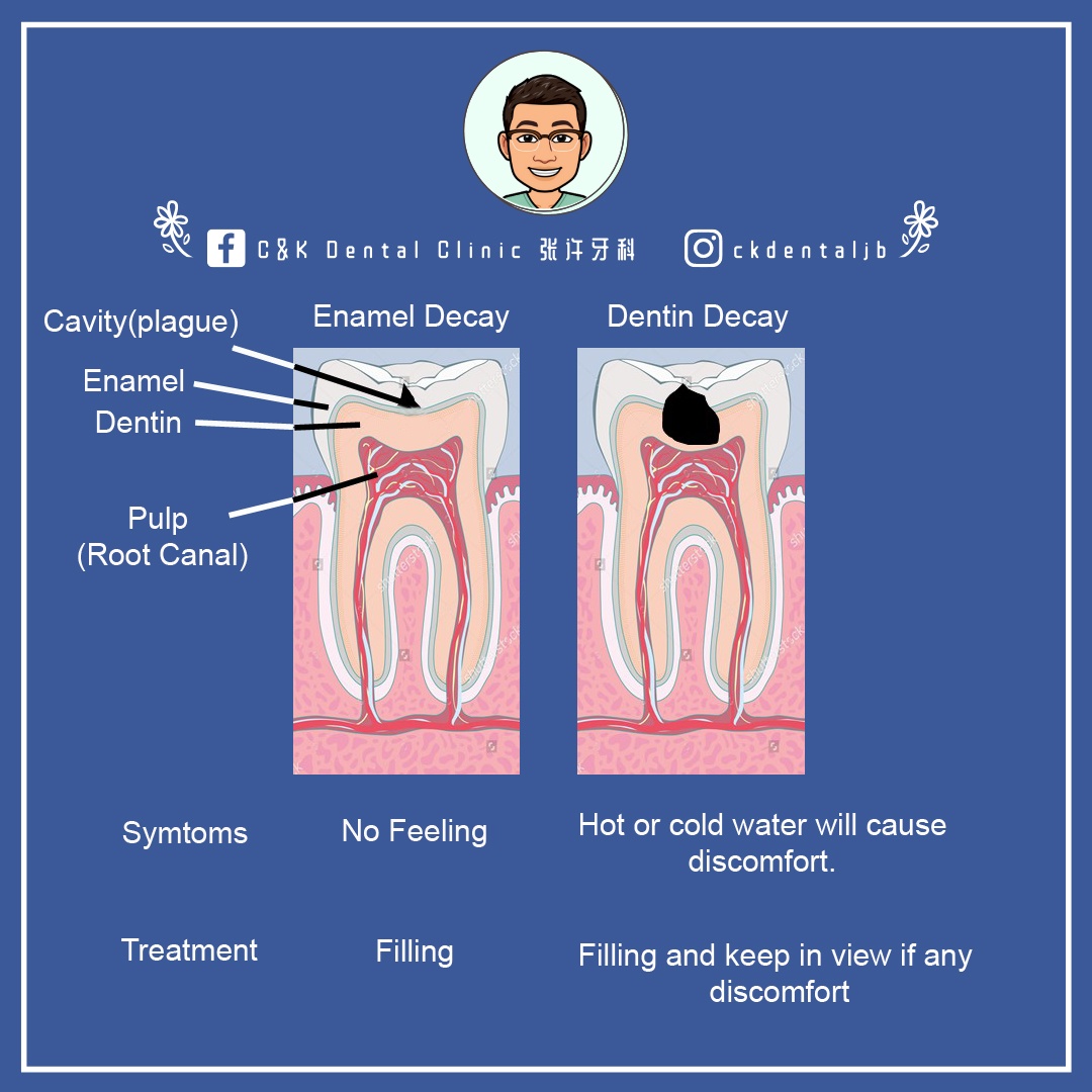 Wisdom Tooth