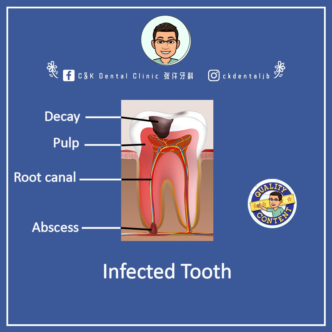 Wisdom Tooth