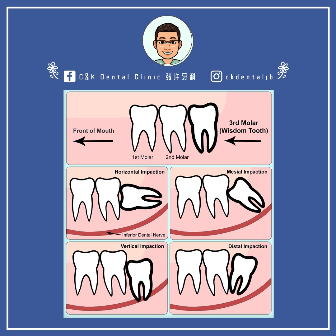 Wisdom Tooth