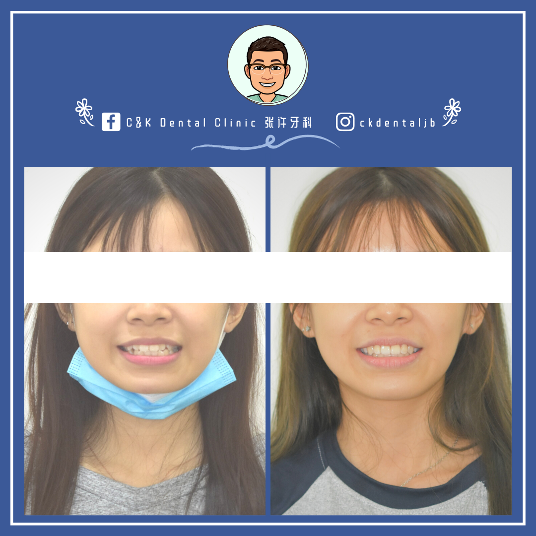 Wisdom Tooth