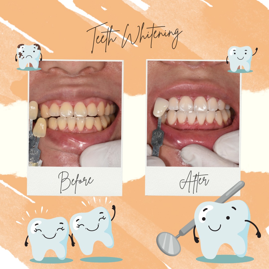 Wisdom Tooth