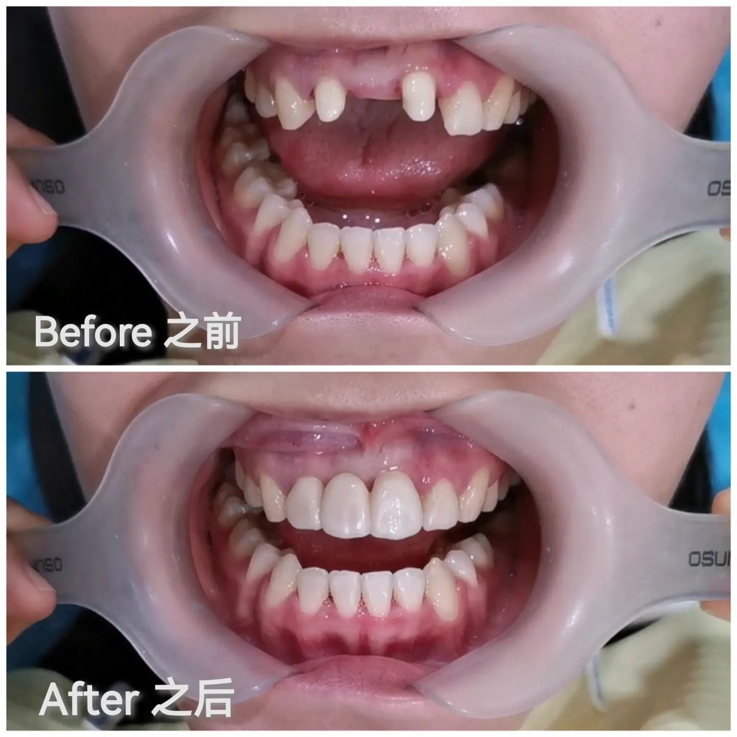 Wisdom Tooth