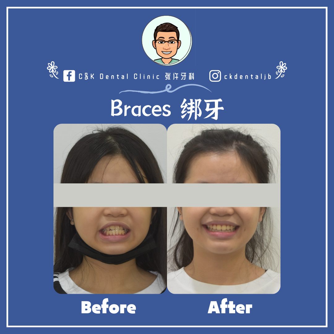 Wisdom Tooth