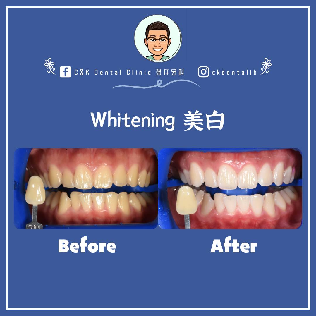 Wisdom Tooth