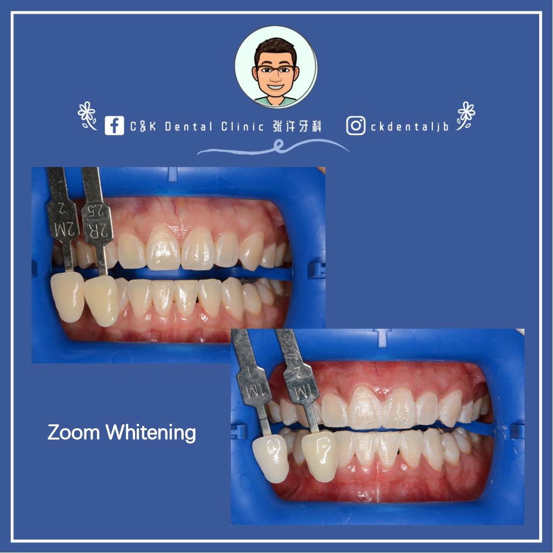 Wisdom Tooth