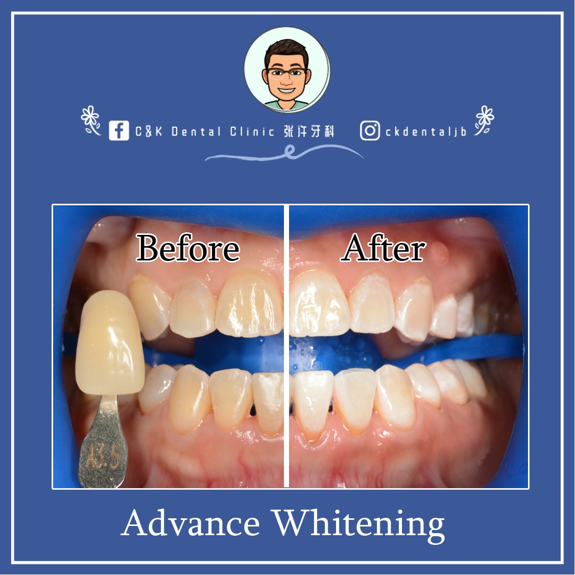 Wisdom Tooth