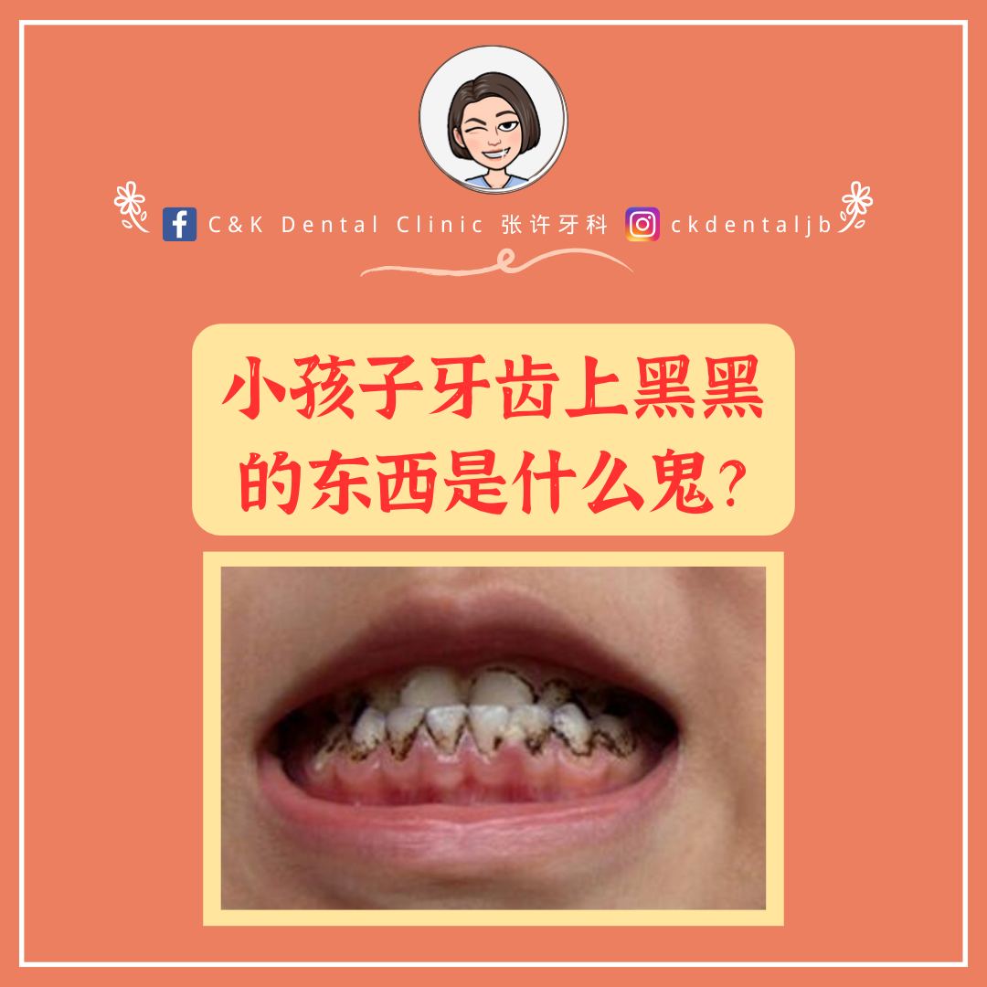 Wisdom Tooth
